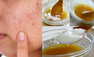 Masque maison et naturel contre l'acné (3 ingrédients seulement!)