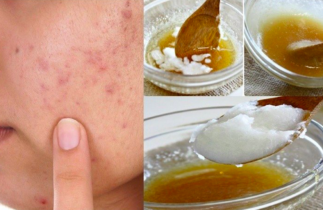 Masque maison et naturel contre l'acné (3 ingrédients seulement!)