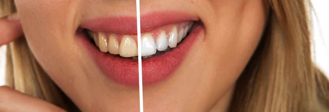astuces naturelles pour avoir des dents plus blanches