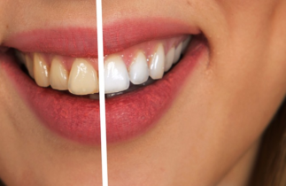 astuces naturelles pour avoir des dents plus blanches