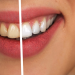 astuces naturelles pour avoir des dents plus blanches