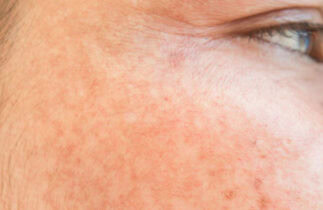 astuces naturelles contre les taches brunes de la peau