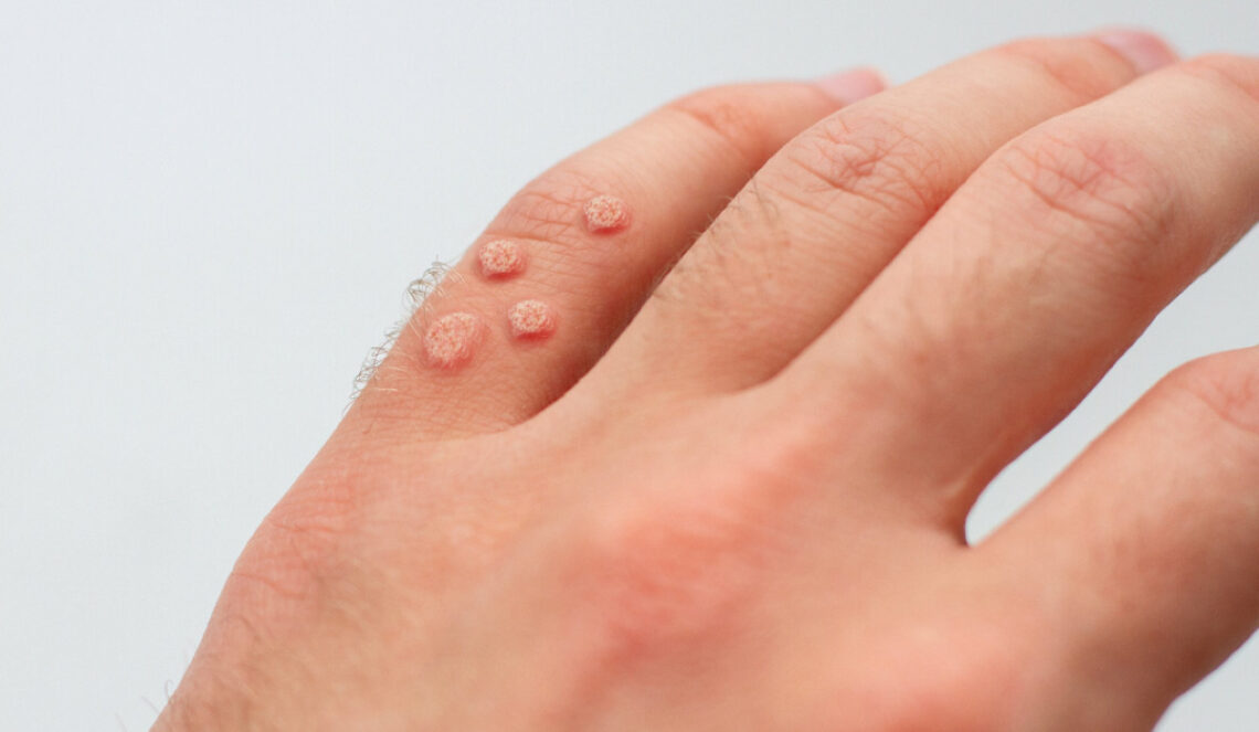 3 façons naturelles de se débarrasser des verrues