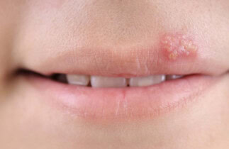 4 traitements naturels contre les feux sauvages